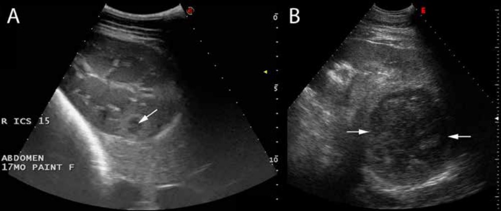 Renal abscessation in equine pigeon fever: Horse A showing a small kidney abscess (left) and Horse B showing a very large abscess in the right kidney (right).